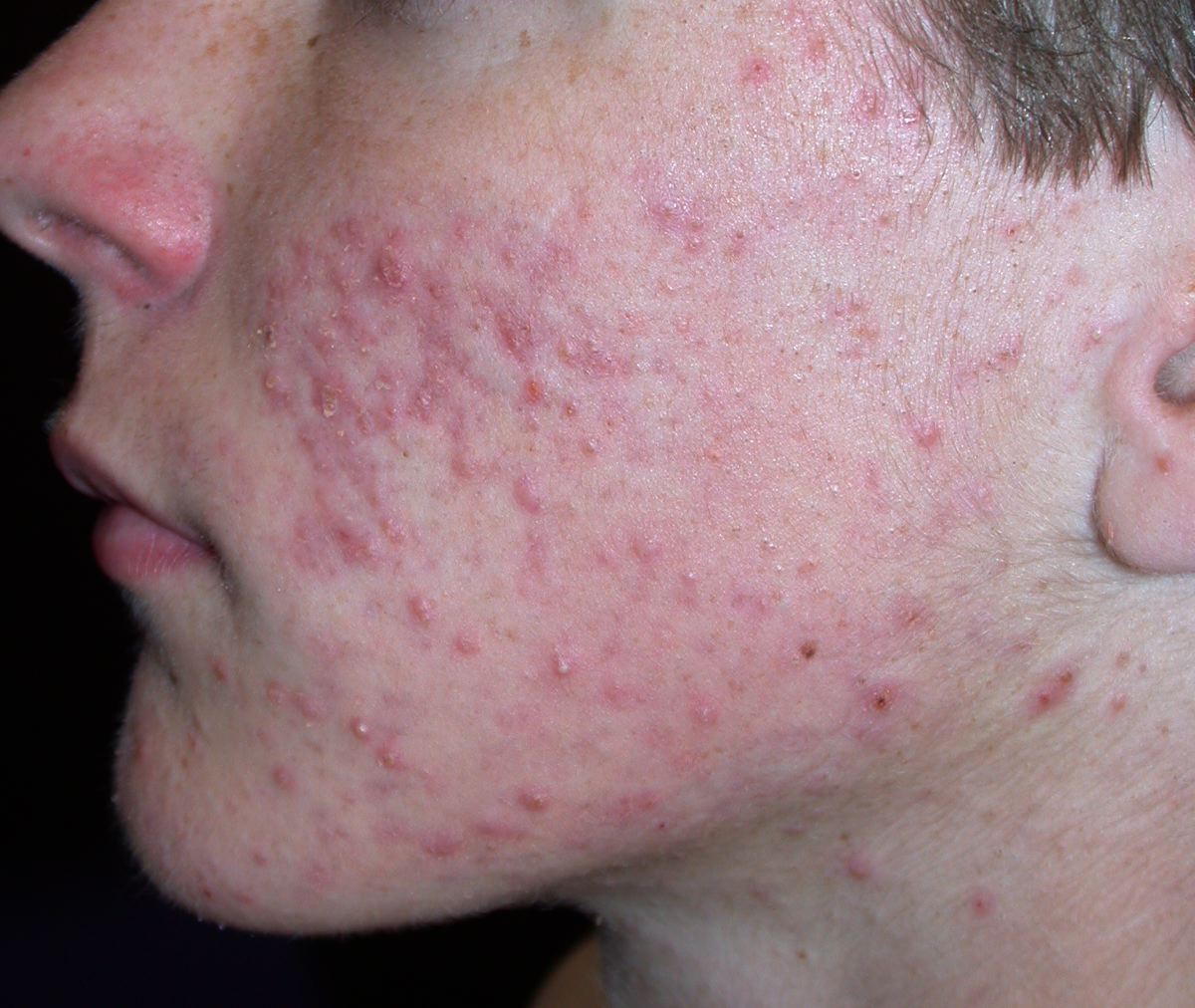 Acne