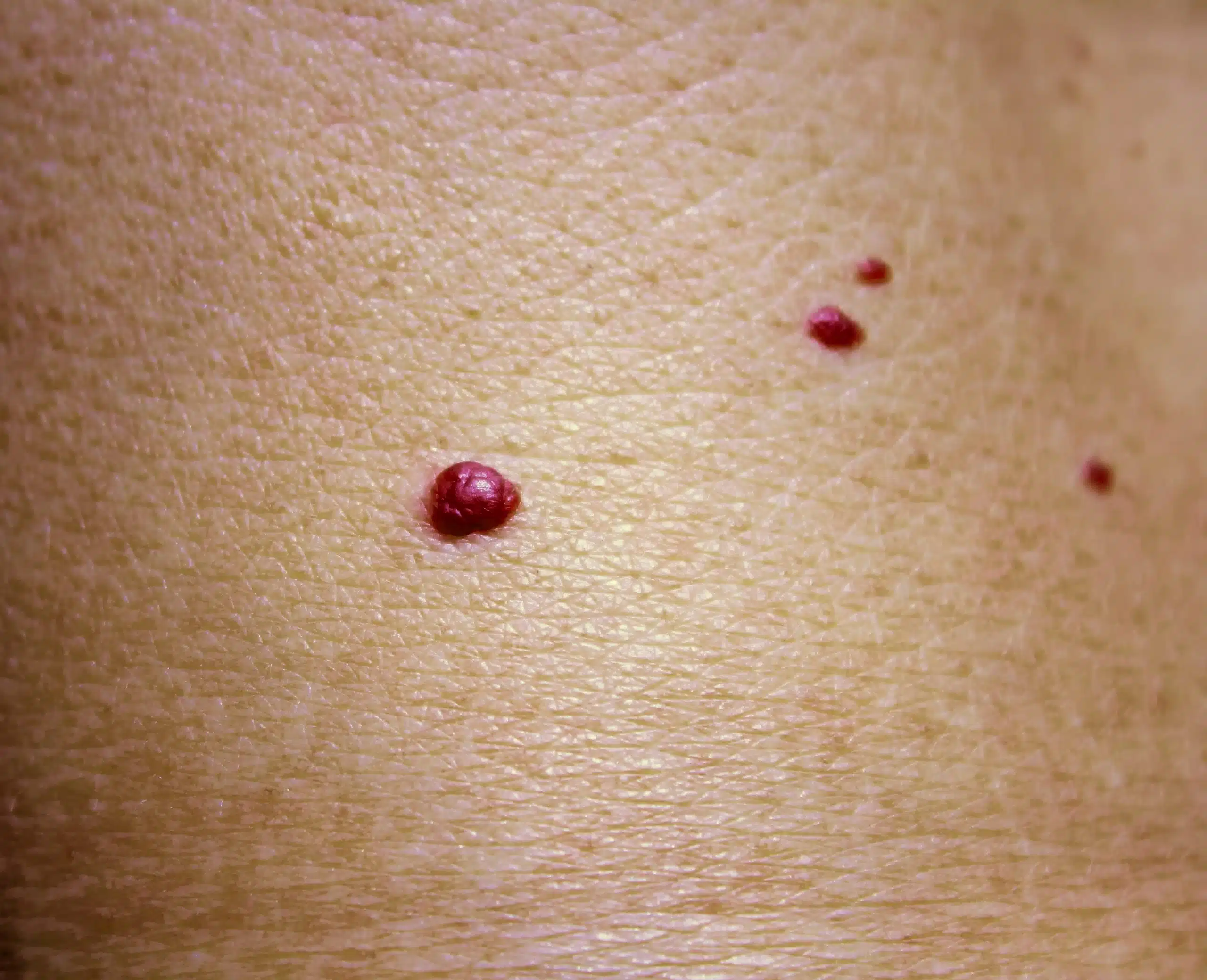 Cherry angiomas