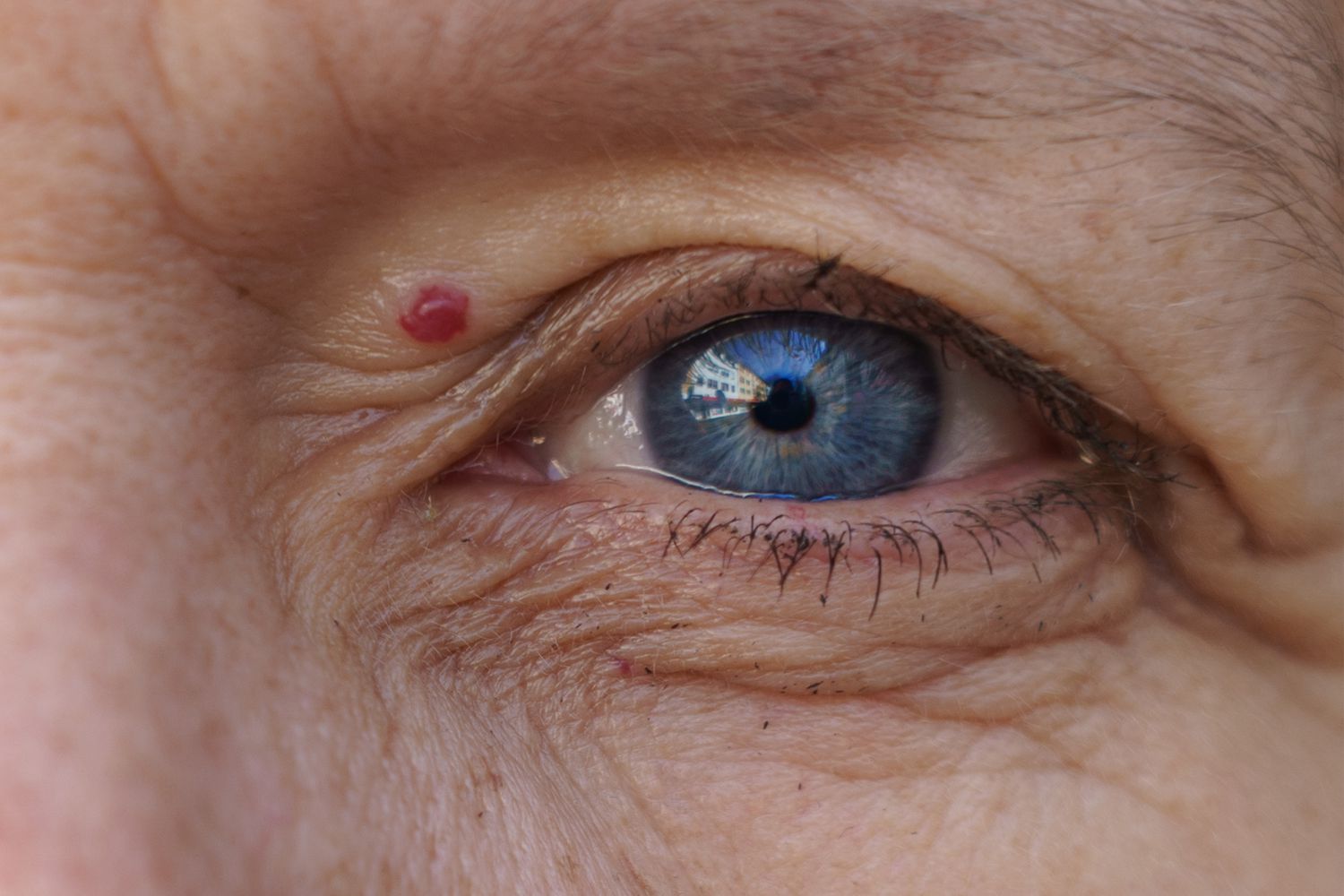 Hemangiomas and angiomas