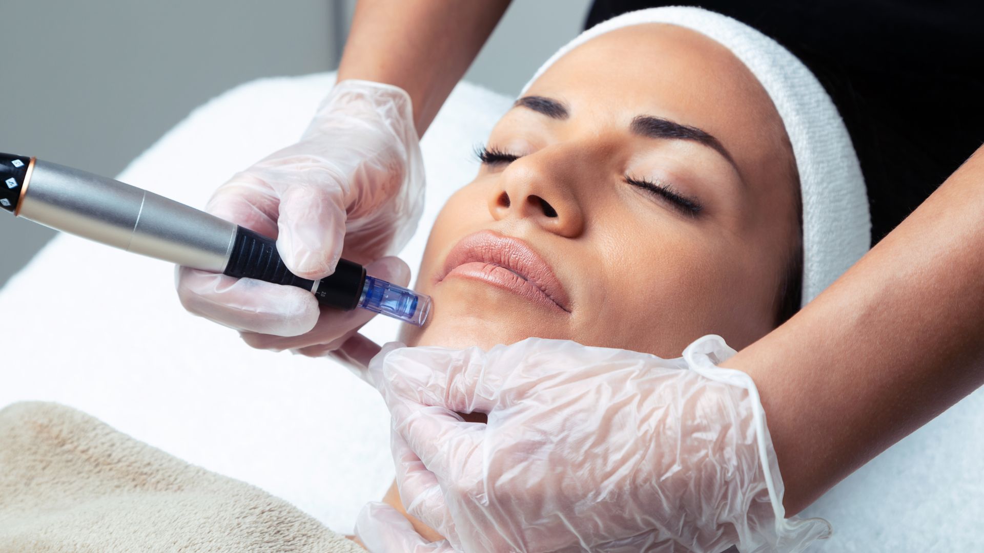 Micro-Needling in Vancouver, WA