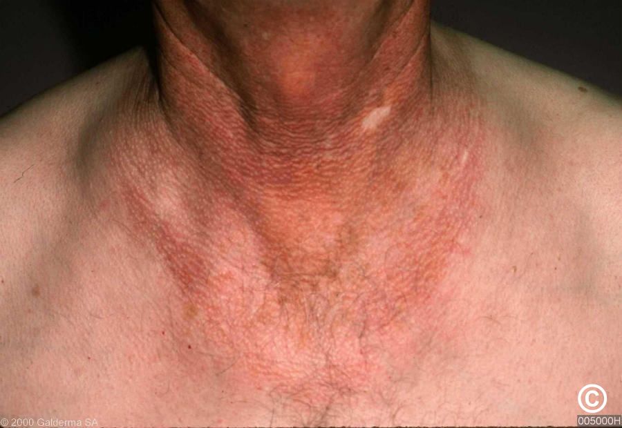 Poikiloderma of Civatte