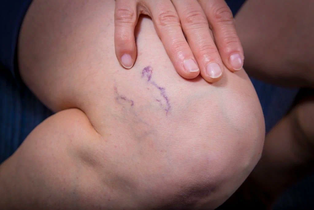 Spider veins, both facial and leg