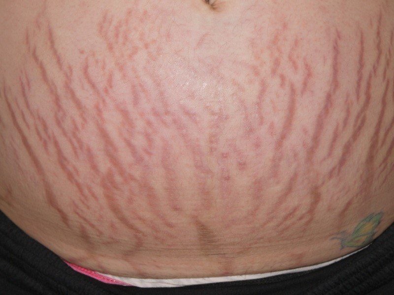 Striae