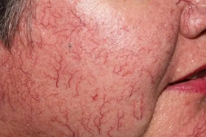 Telangiectasias