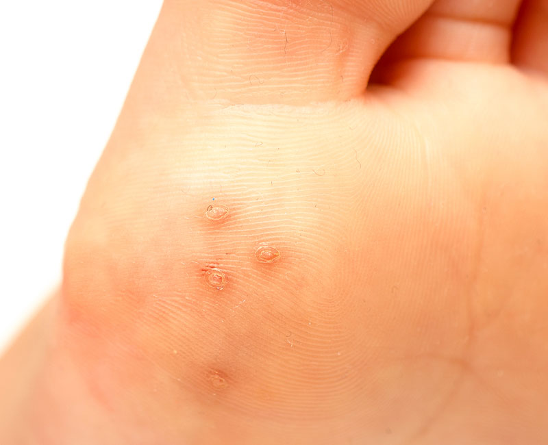 Warts